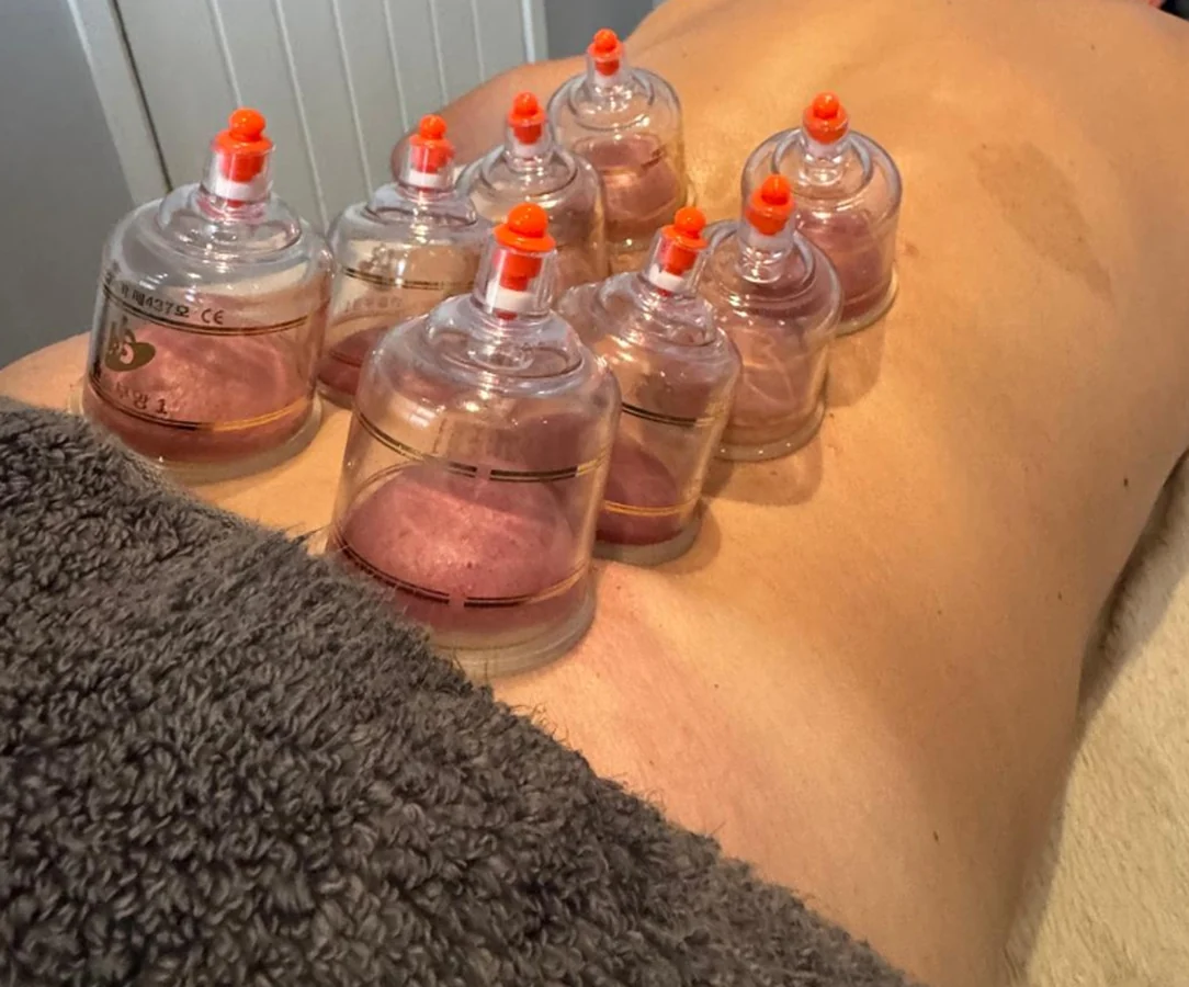 Dry cupping treatment applied to a client's back
